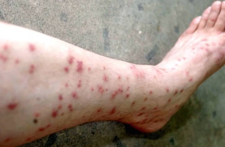 What Do Sand Flea Bites Look Like On Humans