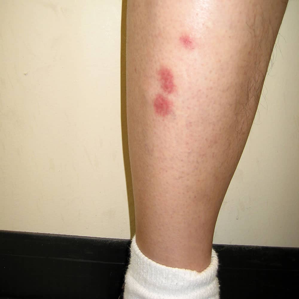 bed-bug-bite-on-leg