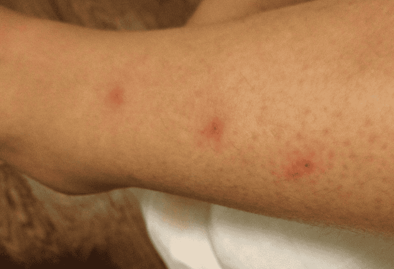 Carpet Beetle Bites Allergic Reaction